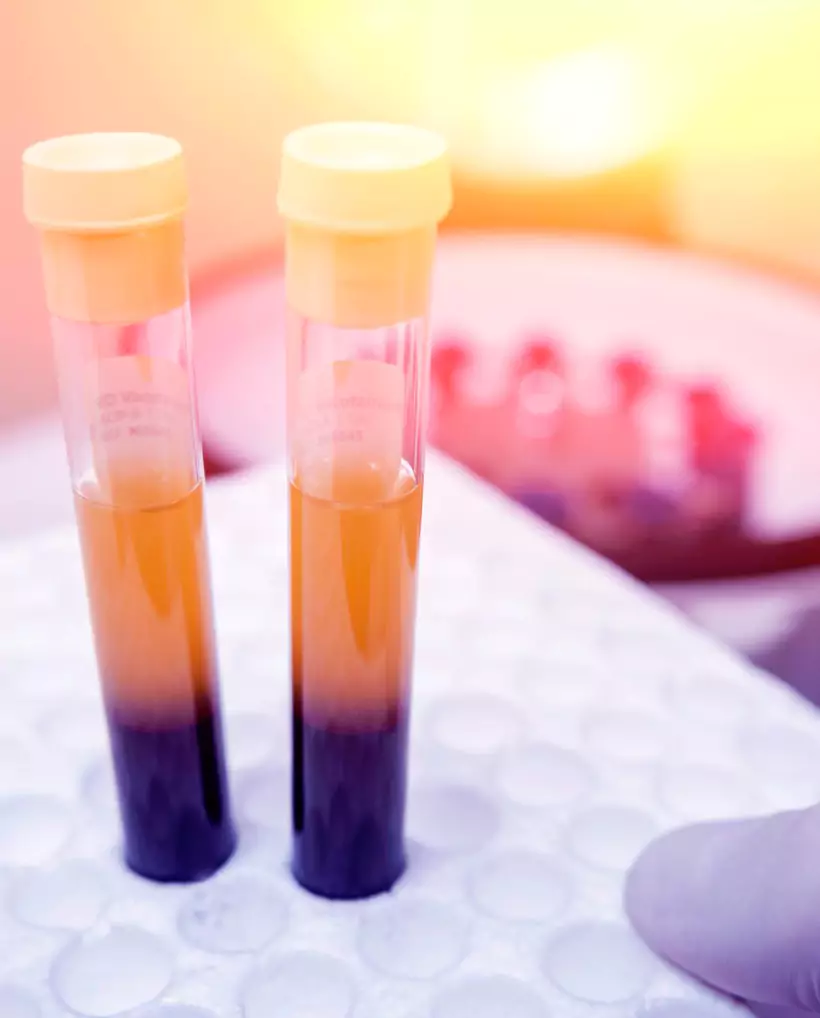 Platelet -rich Plasma (PRP)